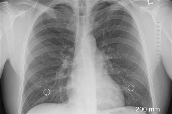 夢到了得肺癌意味著什麼_周公解夢