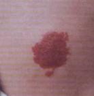 Nevus flammeus