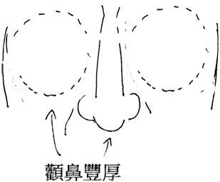 Zygomatic feng nose thick