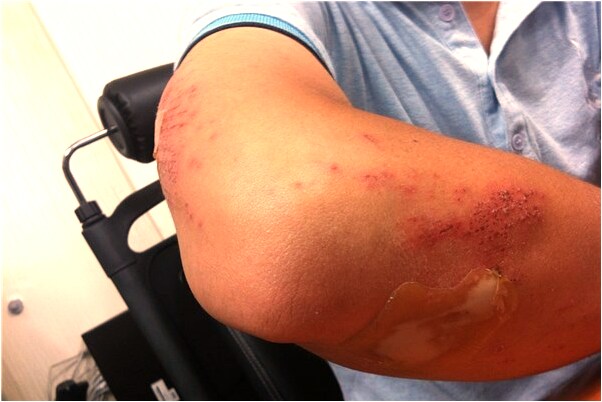 夢見食物中毒吐血代表什麼_周公解夢官網