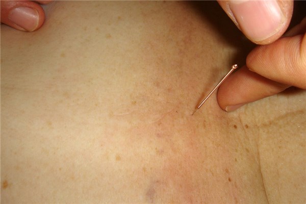 夢到艾灸怎么說_周公解夢