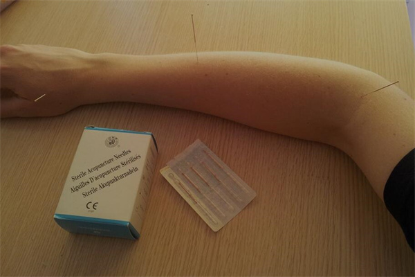 夢到針炙有什麼預示嗎_周公解夢