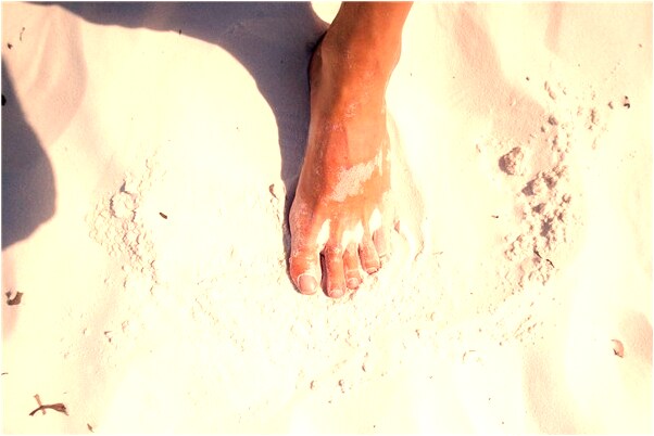 夢見自己全身起了疹子什麼預兆_周公解夢官網