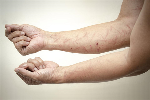 夢到了手臂出血有什麼意思_周公解夢