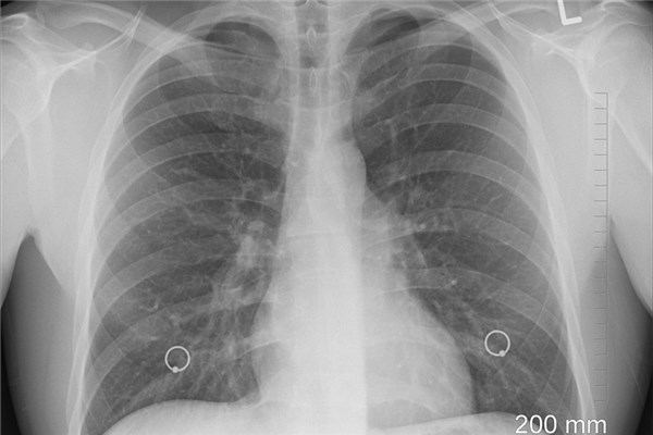 夢見自己得了肺癌什麼預兆_周公解夢